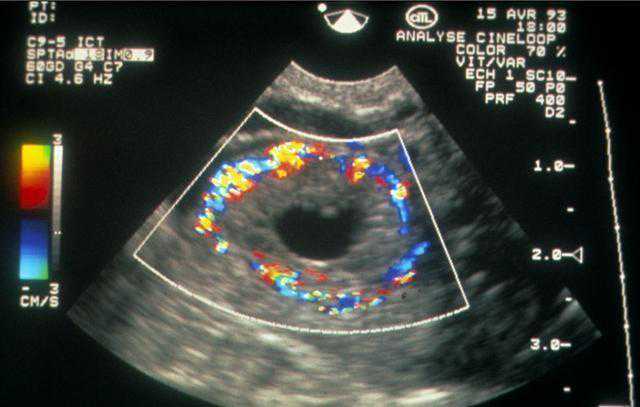 切除子宫还能怀孕_生育后切除子宫,卵巢早衰可以做美国试管婴儿吗？