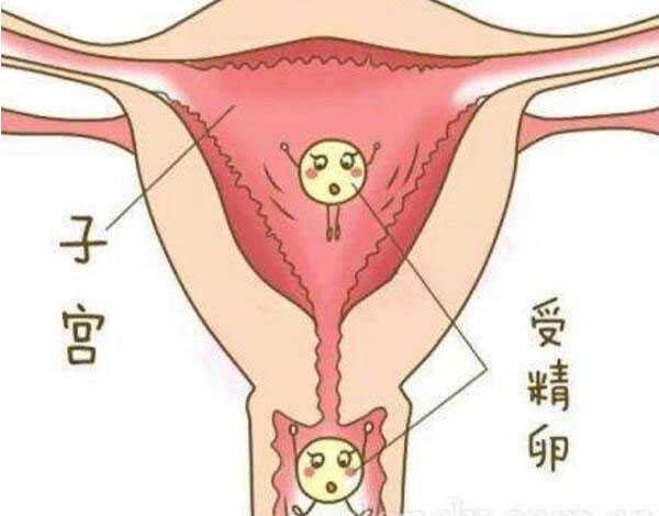 什么是生化妊娠？泰国试管婴儿可以避免生化妊娠实现好孕吗？